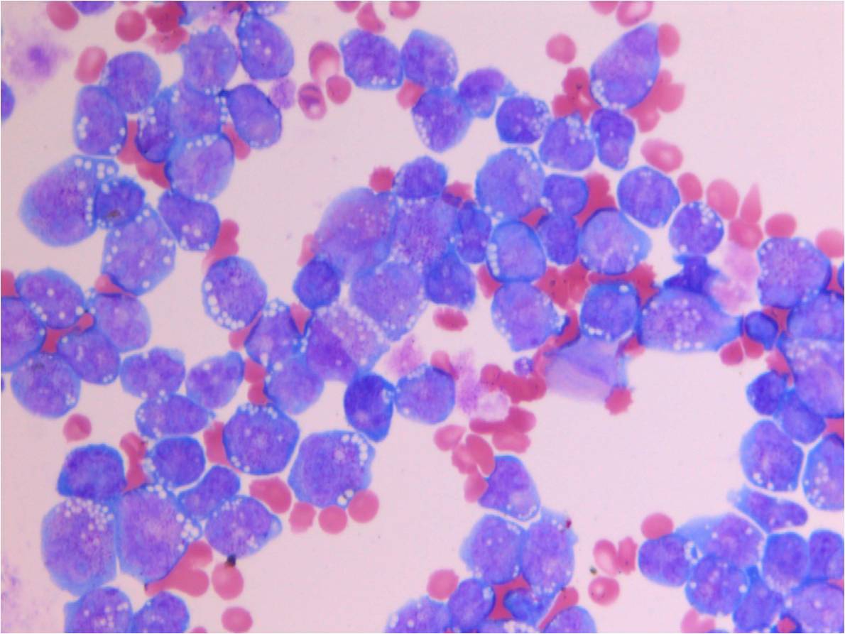 APL, ascites fluid