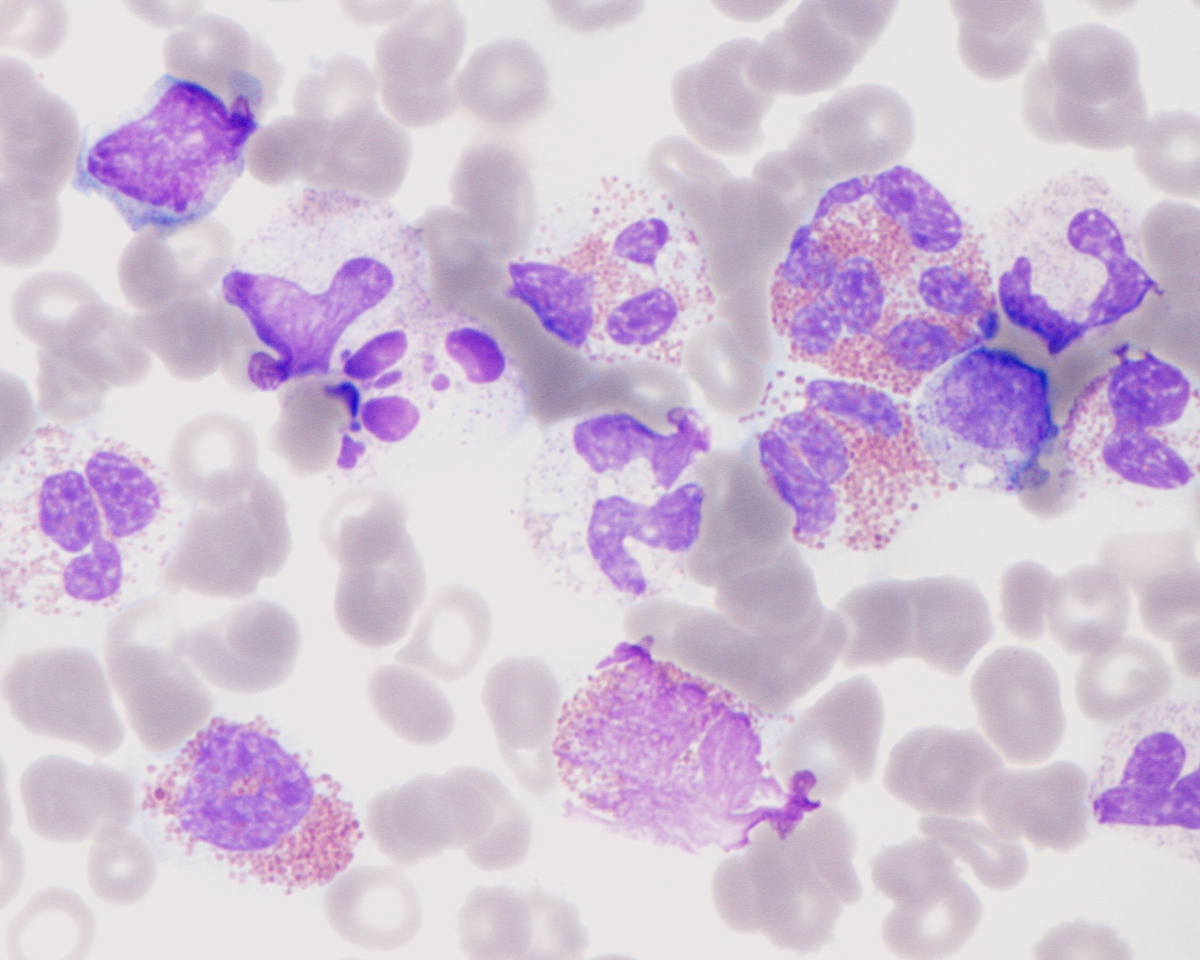 Peripheral blood 600X Dysplastic neutrophils and eosinophils including a hyperlobate eosinophil in upper right and eosinophil with ringed nucleus in lower left
