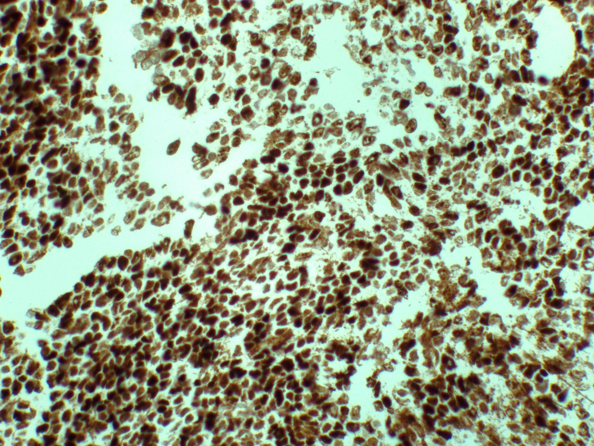 TdT stain on aspirate