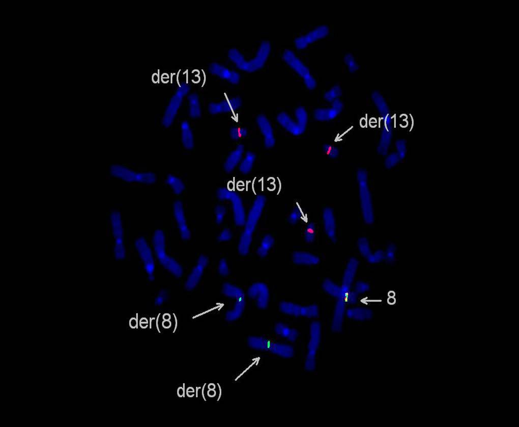 Metaphase FISH in second marrow shows involvement of FGFR1 in t(8;13) in second cell line (breakapart probe)