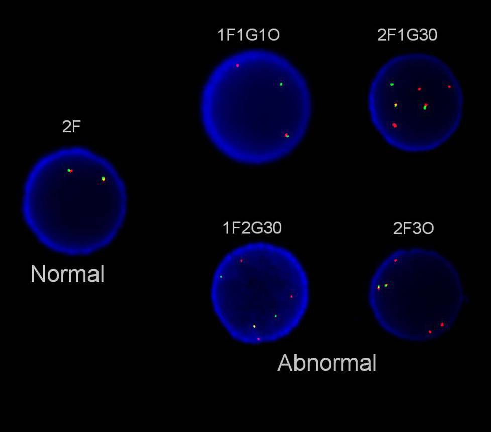 Interphase FISH in second marrow shows involvement of FGFR1 in t(8;13) - breakapart probe was used.