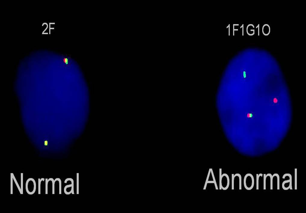 Interphase FISH in lymph node with bilineal lymphoma shows FGFR1 rearrangement (breakapart probe).