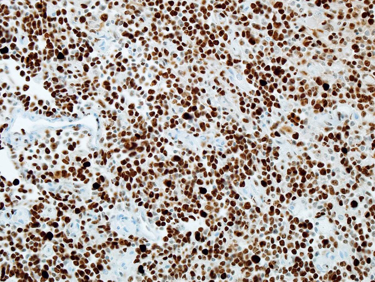 Immunostain for Ki67 shows Ki67 positivity in almost 100% cells.