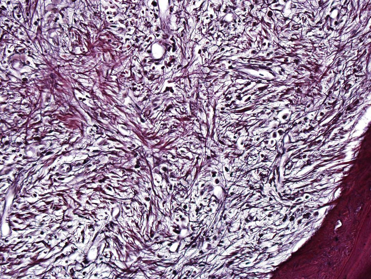 Reticulin stain shows marked reticulin fibrosis.
