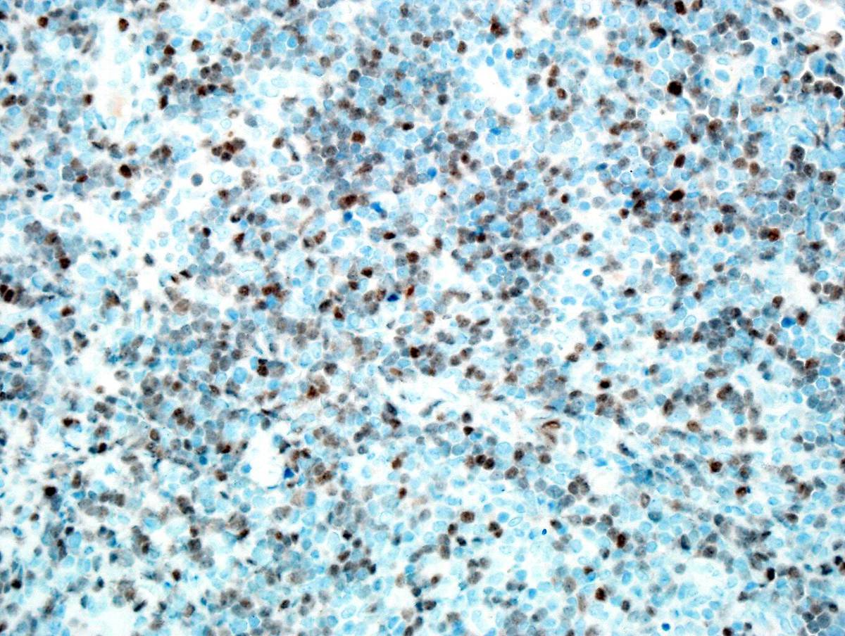 Immunostain for TdT is positive in the blasts in the lymph node.