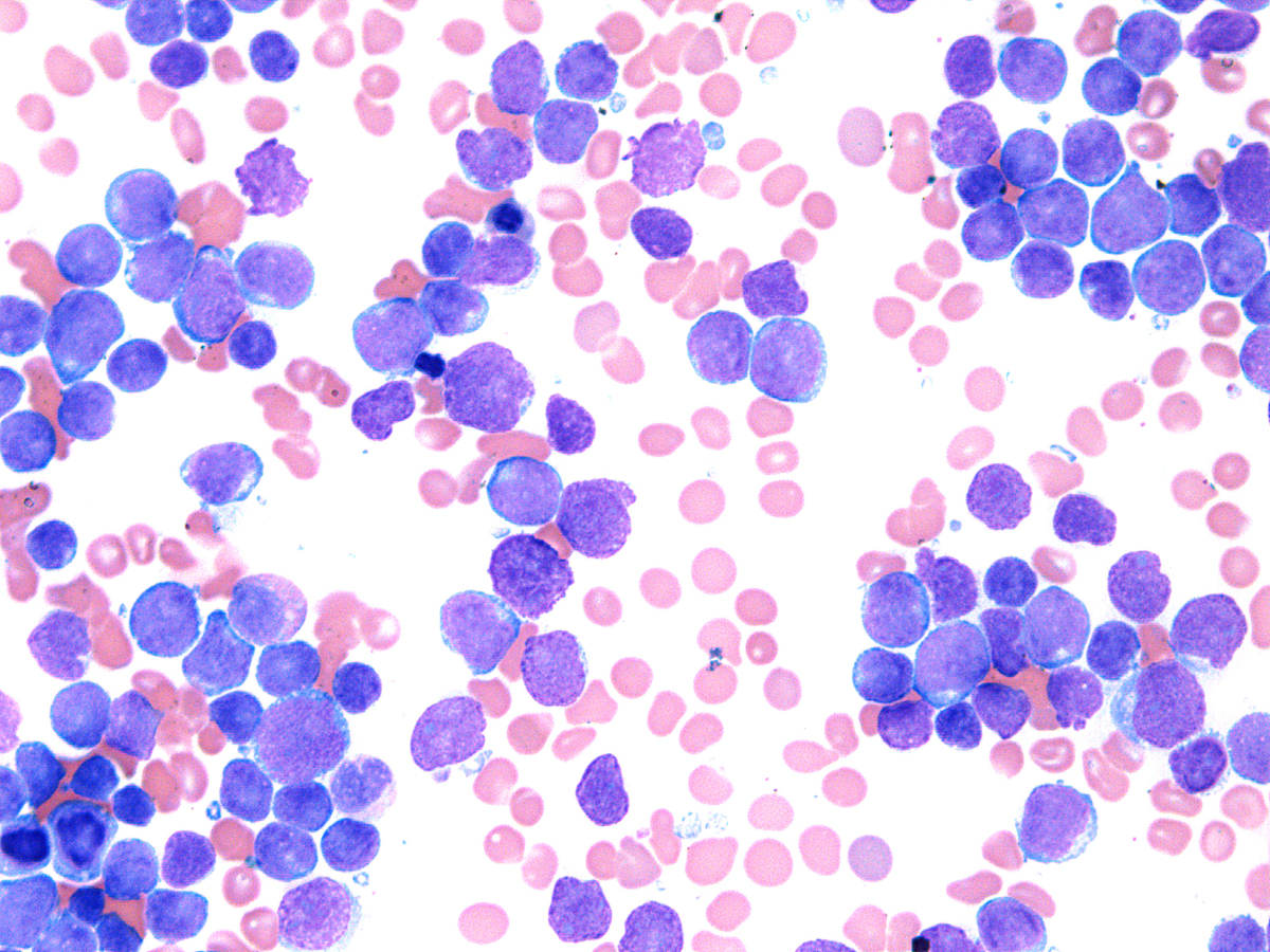 Bone marrow aspirate, 2 months prior to CART-19 infusion, Wright-Giemsa, 50x: Numerous blasts accounting for 87% of total cellularity and rare maturing erythroid precursors are identified.