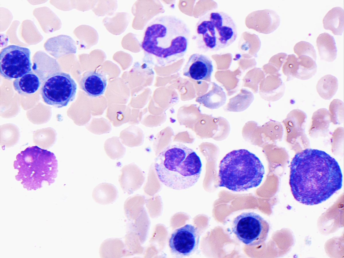 Bone marrow aspirate (Case S-12-005152), 3 months post CART-19 infusion, Wright-Giemsa, 100x: No evidence of residual leukemia is identified.