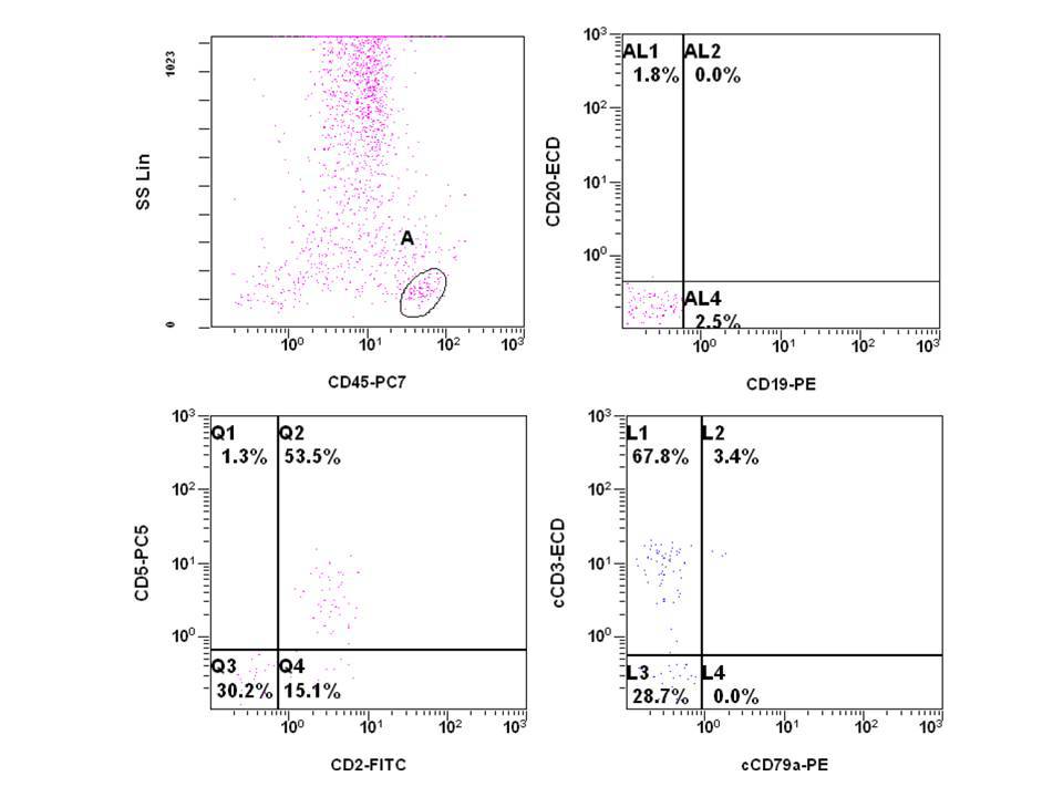 Bone marrow aspirate, 3 months post CART-19 infusion, flow cytometry: Flow cytometry shows immunophenotypically normal T cells and virtually no B cells.