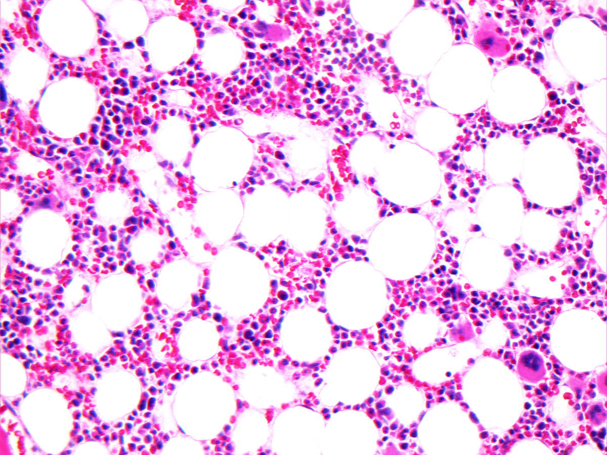Bone marrow core biopsy (Case S-12-007268), 6 months post CART-19 infusion, H&E, 20x: Bone marrow biopsy obtained six months post CART-19 shows a normocellular marrow with trilineage hematopoiesis, and no evidence of leukemia.