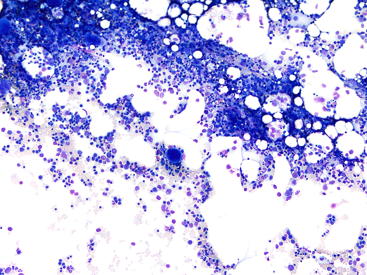Bone marrow aspirate (Case S-12-005152), 3 months post CART-19 infusion, Wright-Giemsa, 10x: Three months post-treatment, the aspirate smear shows a mildly hypocellular marrow with trilineage hematopoiesis.
