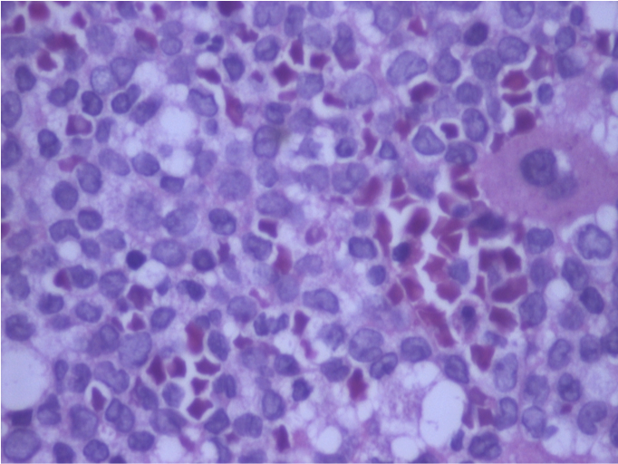 BM biopsy