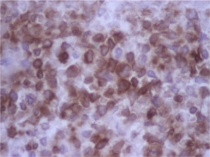 CD3 BM biopsy