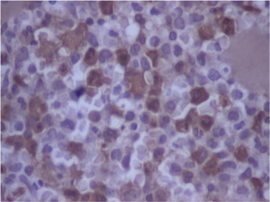 MPO in BM biopsy