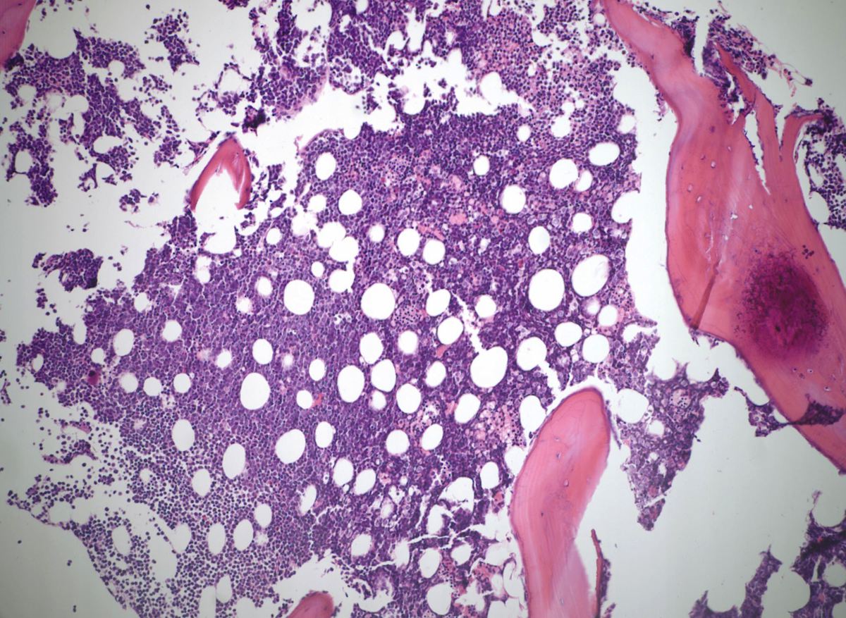 Low power view of bone marrow core biopsy showing hypercellular marrow