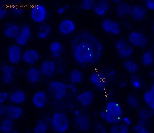 FISH image showing trisomy 8 in immature myeloid cells in pleural EMH