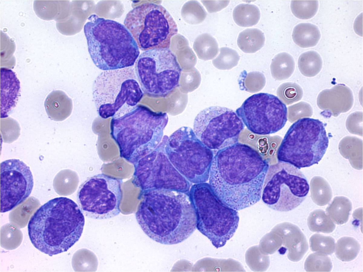 Bone Marrow Aspirate 100x #2