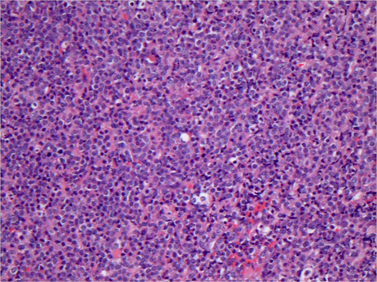 Paraspinal Mass 20x