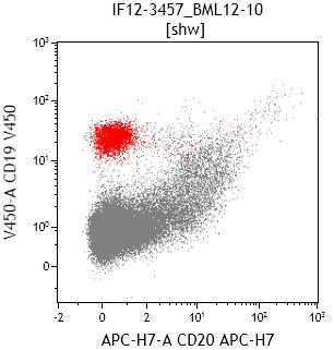 Flow cytometry CD19 and CD20 (blasts in red)
