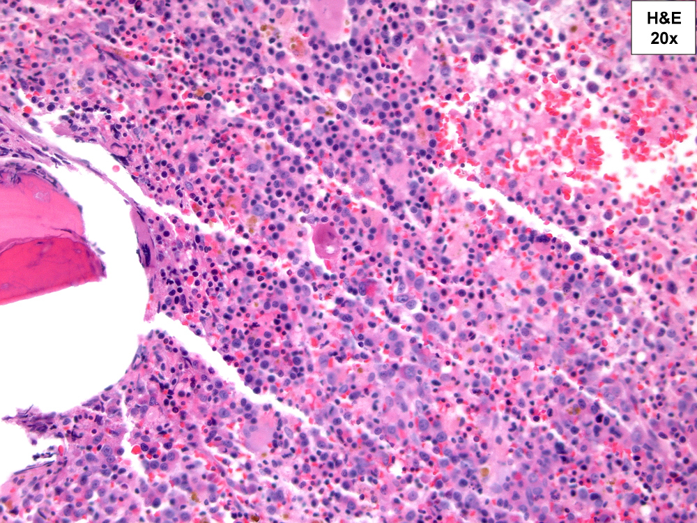H&E, 20X. Erythroid hyperplasia with numerous blasts of indeterminate lineage