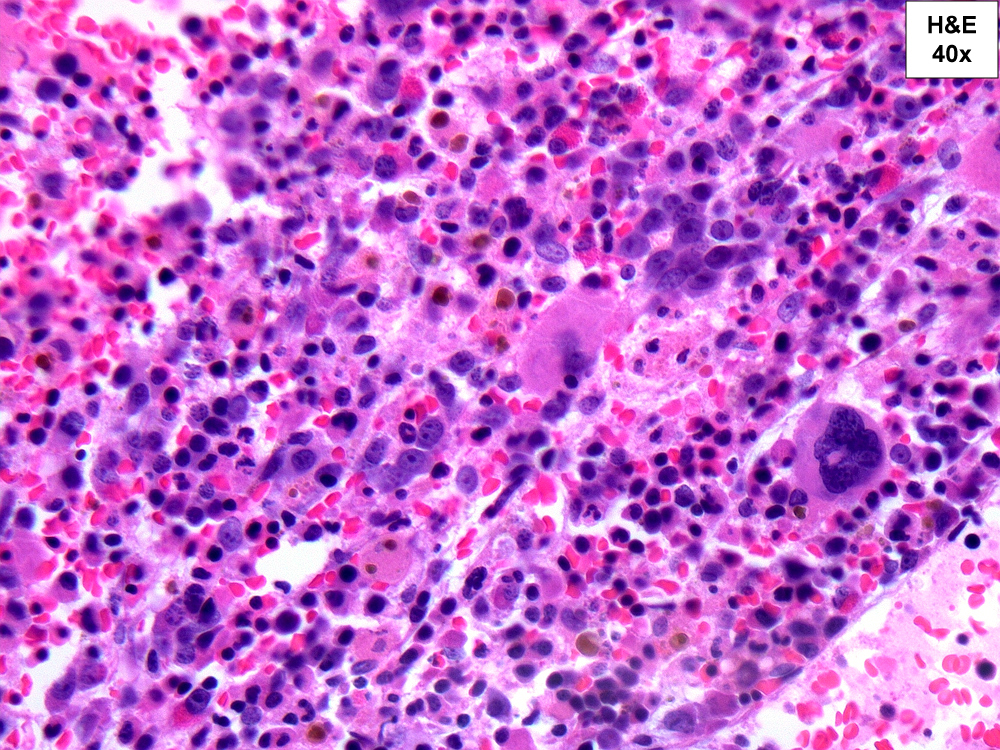 H&E, 40X. Erythroid hyperplasia with numerous blasts of indeterminate lineage and dysplastic megakaryocytes