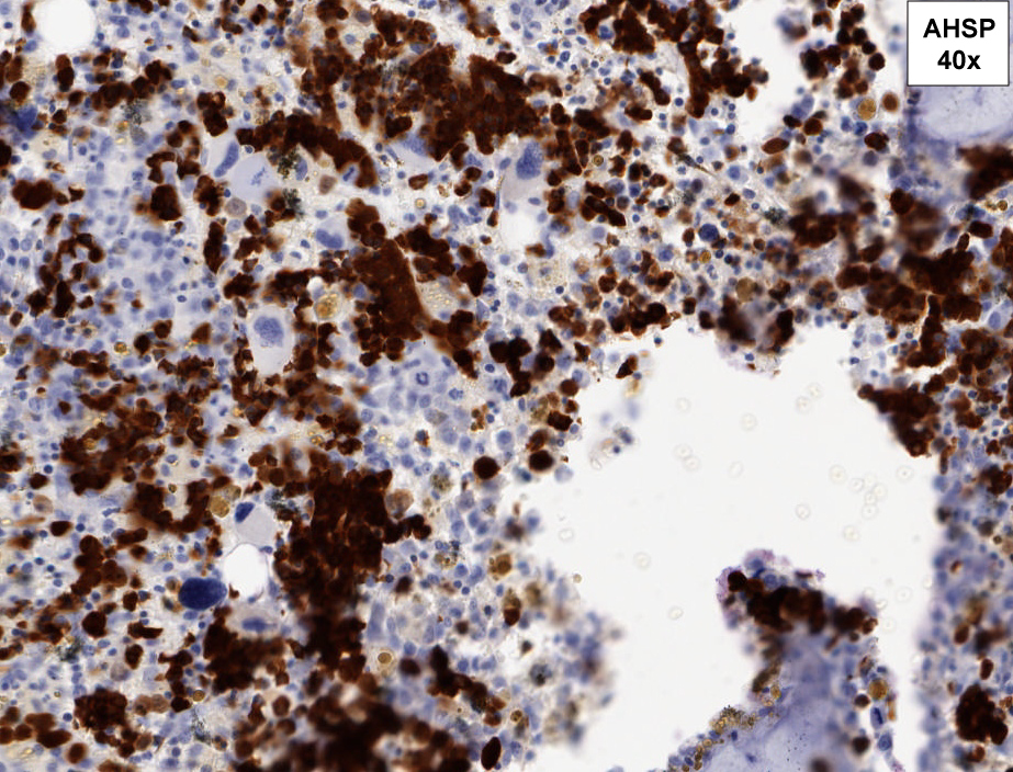 AHSP, 40X. AHSP stains nucleated erythroid precursors and highlights erythroid hyperplasia and architectural disarray of erythroid precursors