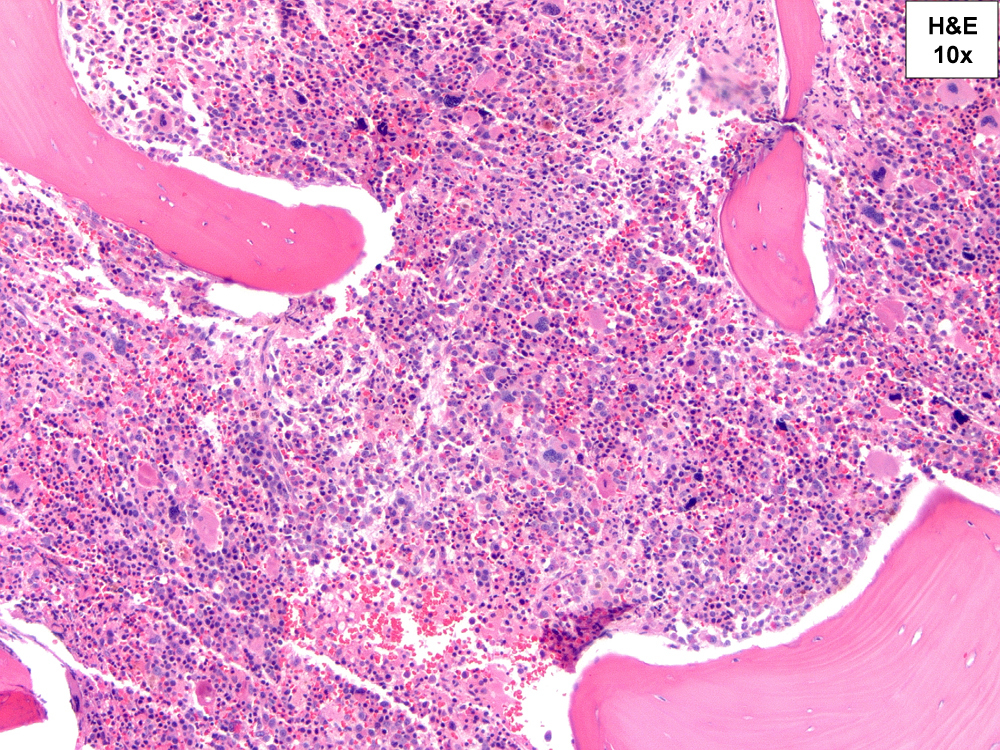 H&E, 10X. Hypercellular marrow with erythroid hyperplasia and numerous blasts and dysplastic megakaryocytes