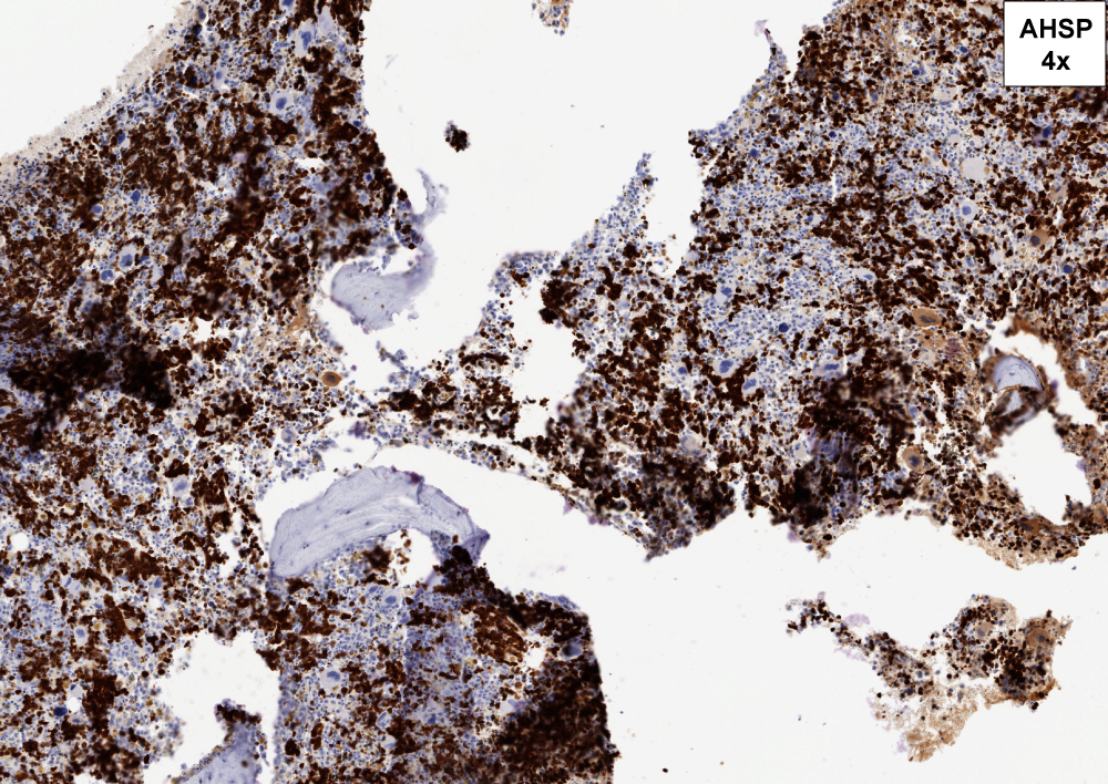 AHSP, 4X. AHSP stains nucleated erythroid precursors and highlights erythroid hyperplasia and architectural disarray of erythroid precursors