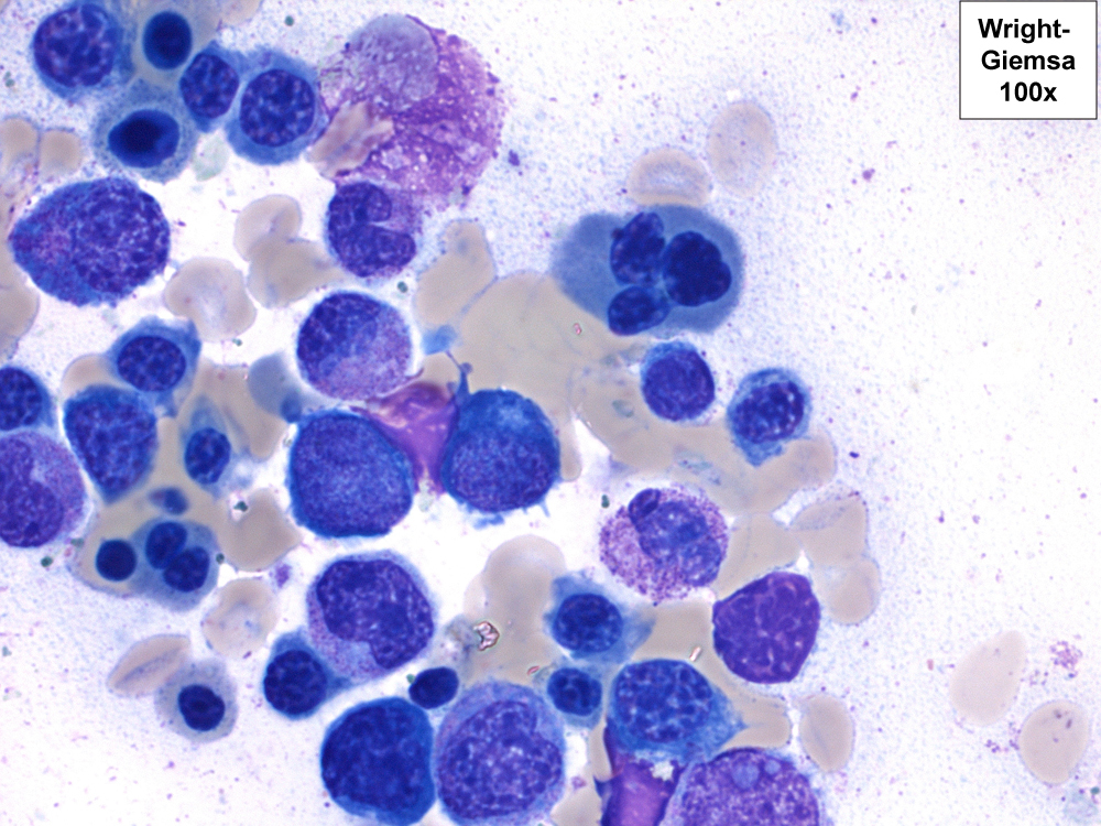 Dysplastic erythroid precursors with binucleation and nuclear membrane irregularities