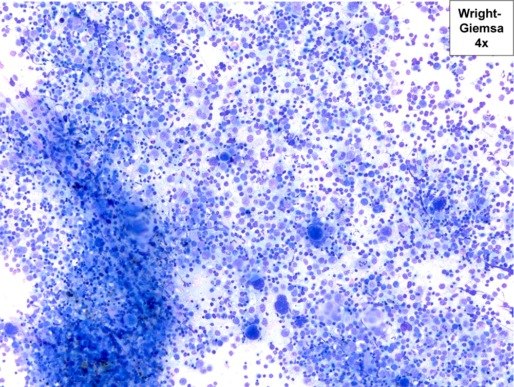 Hypercellular aspirate demonstrating erythroid hyperplasia and dysplastic megakaryocytes