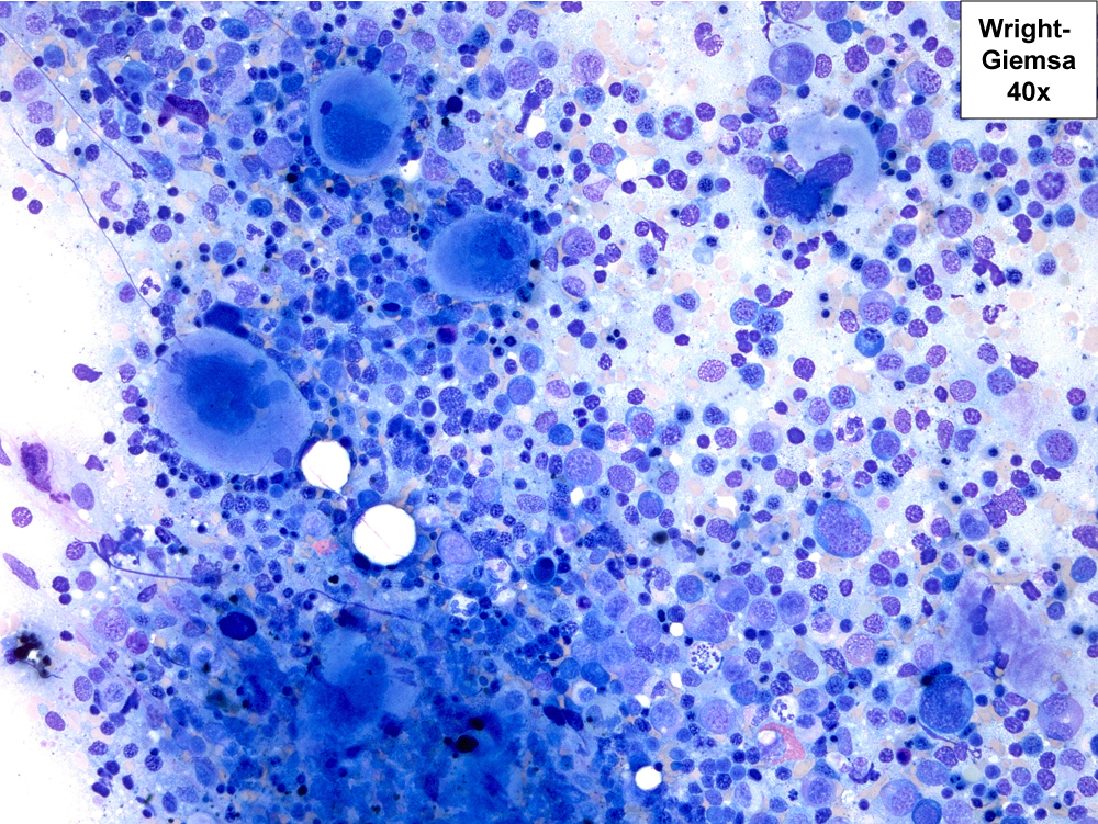 Hypercellular aspirate demonstrating erythroid hyperplasia and dysplastic megakaryocytes