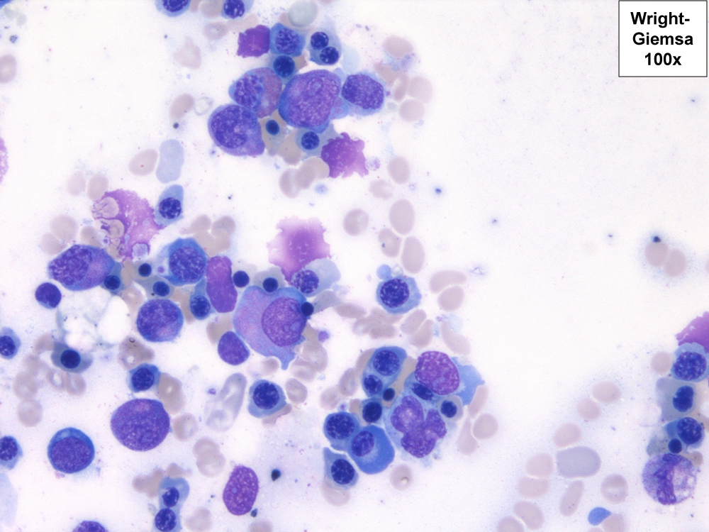 Dysplastic erythroid precursors with binucleation and megaloblastoid changes