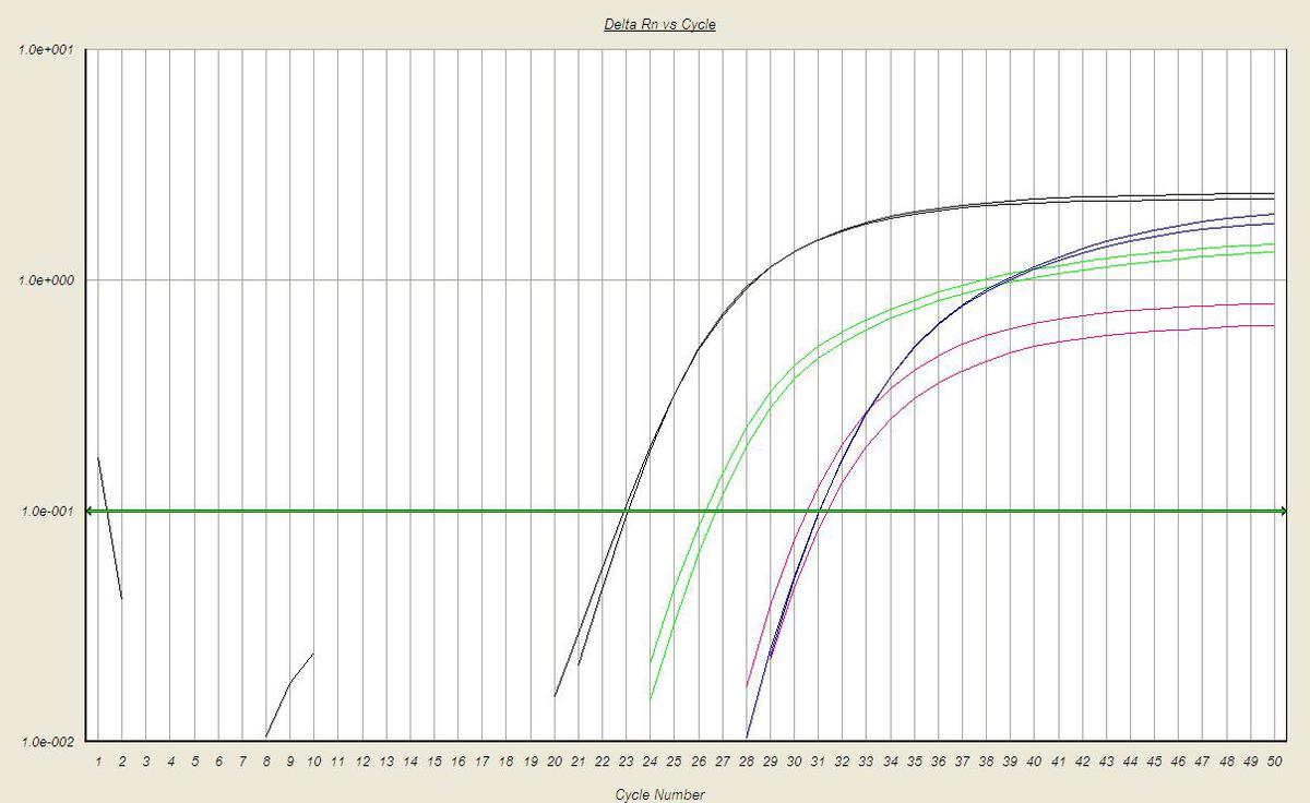 RT-PCR positive for transcripts associated with the Bcr1 form PML-RARA translocation