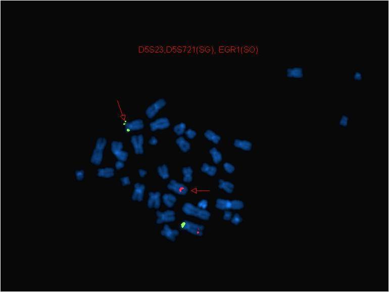 FISH showing ERG probe on X chromosome