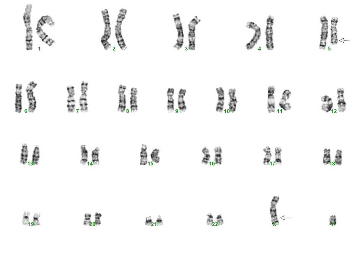 Karyotype showing t(X;5)(q26;q31)