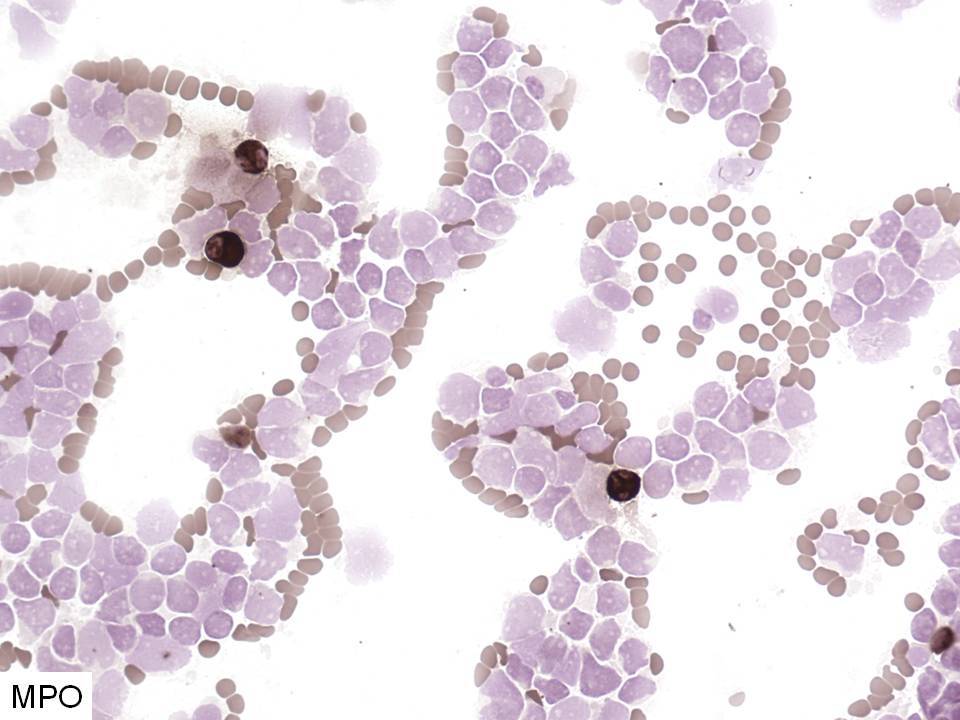 Bone marrow aspirate, myeloperoxidase cytochemistry