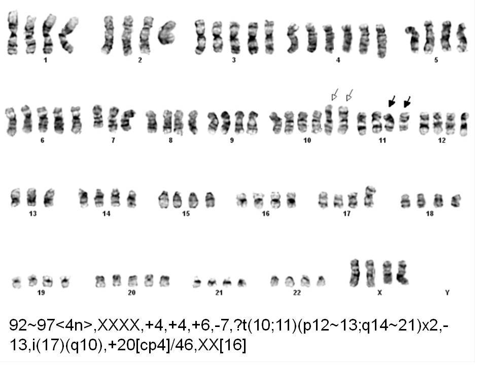 Karyotype, 92~97<4n>,XXXX,+4,+4,+6,-7,?t(10;11)(p12~13;q14~21)x2,-13,i(17)(q10),+20[cp4]/46,XX[16]