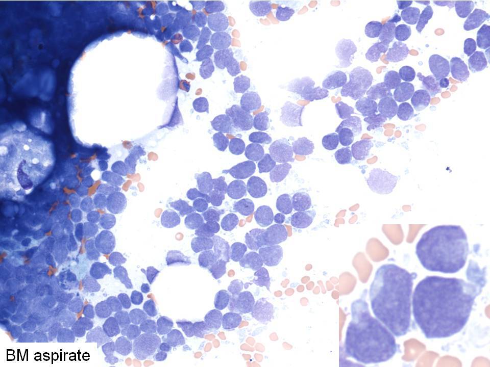 Bone marrow aspirate, demonstrating blasts, cup-like nucleoli