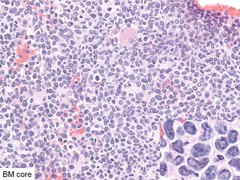 Bone marrow core biopsy, demonstrating blasts