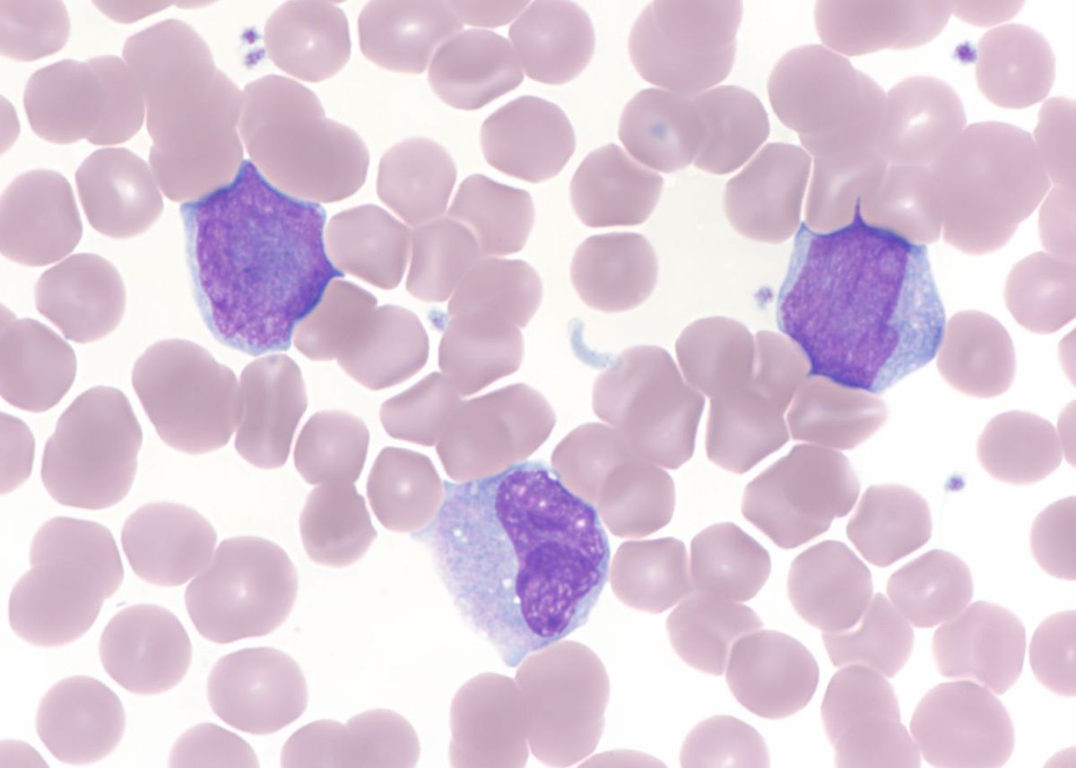 Peripheral blood blasts and abnormal monocytic cells.