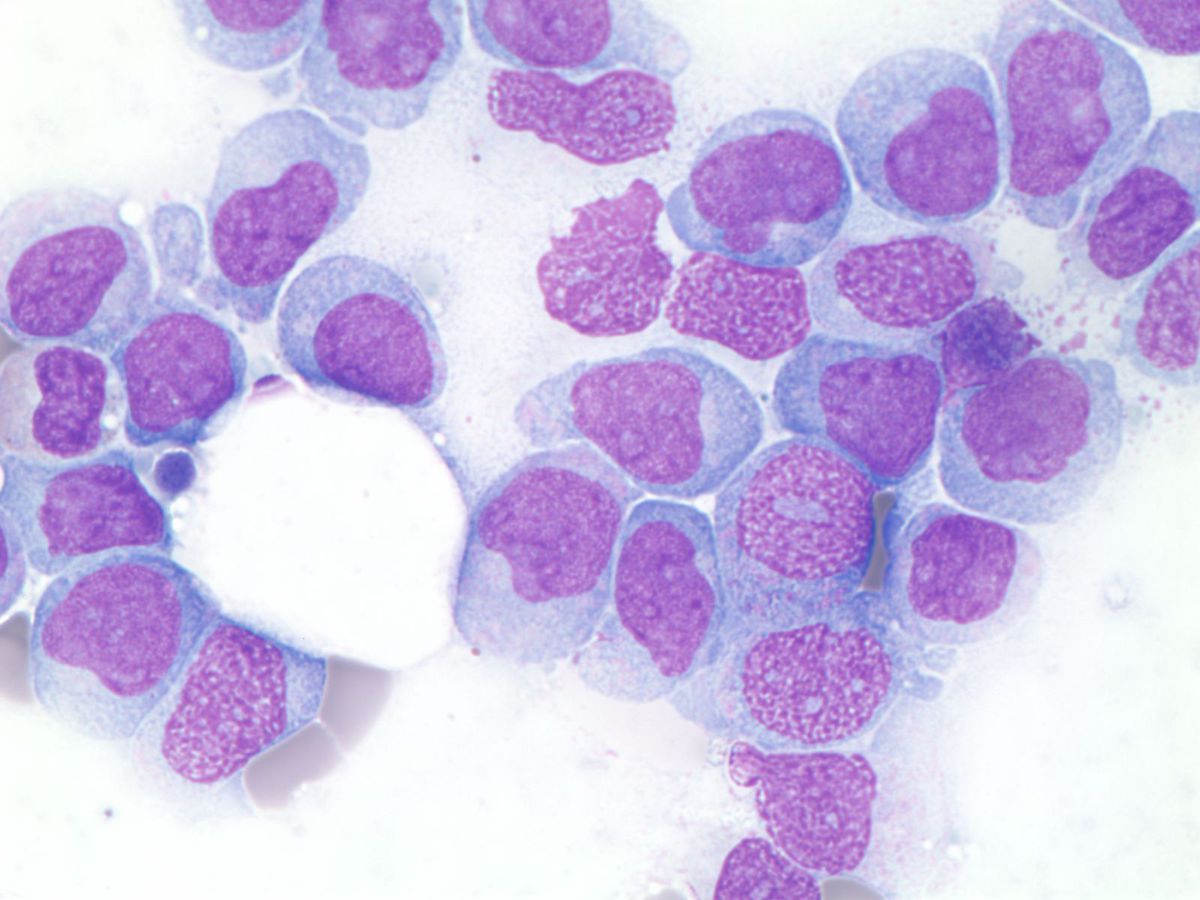 Bone marrow aspirate.
