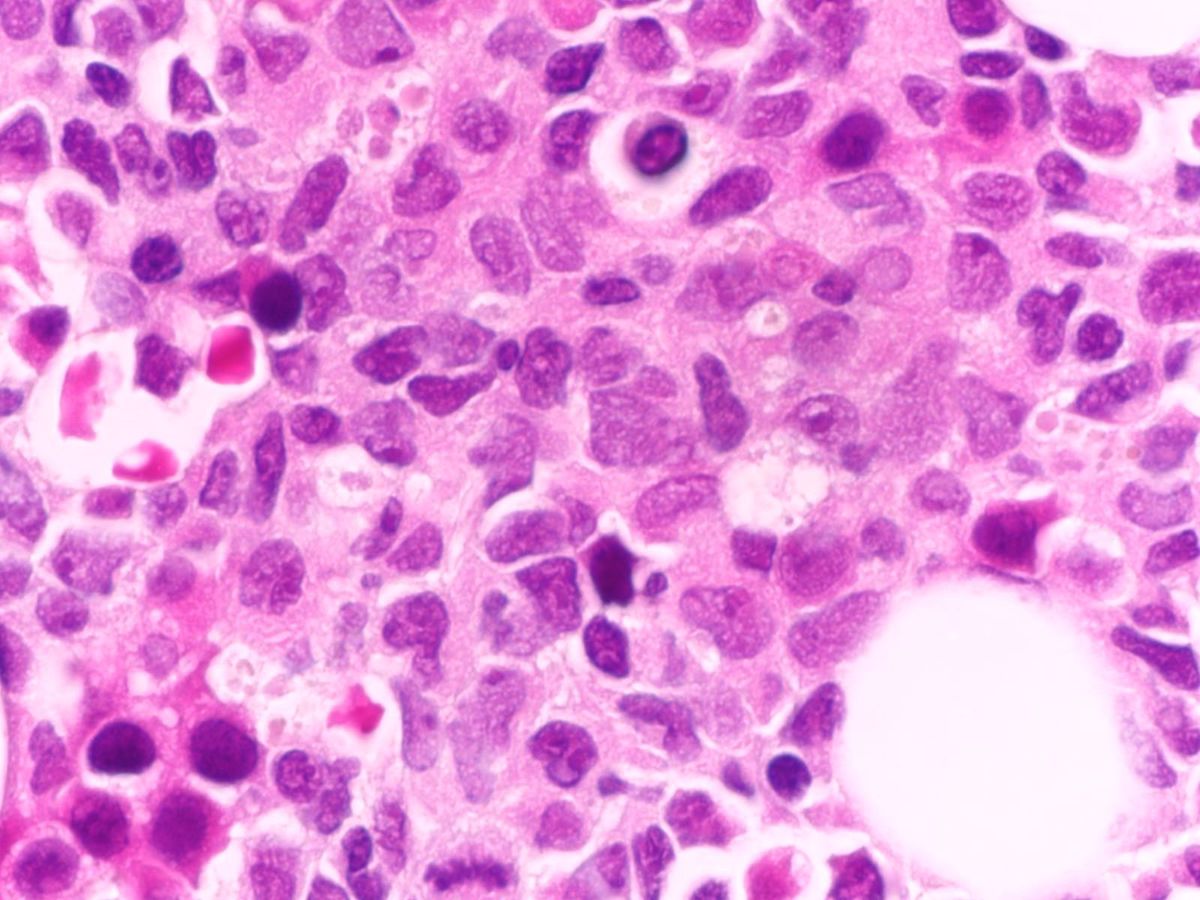 Bone marrow biopsy (1000x)