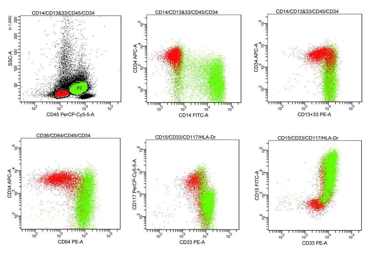 Flow cytometry: Red = CD34+ blasts, Green = Abnormal monocytic / myelomonocytic cells.