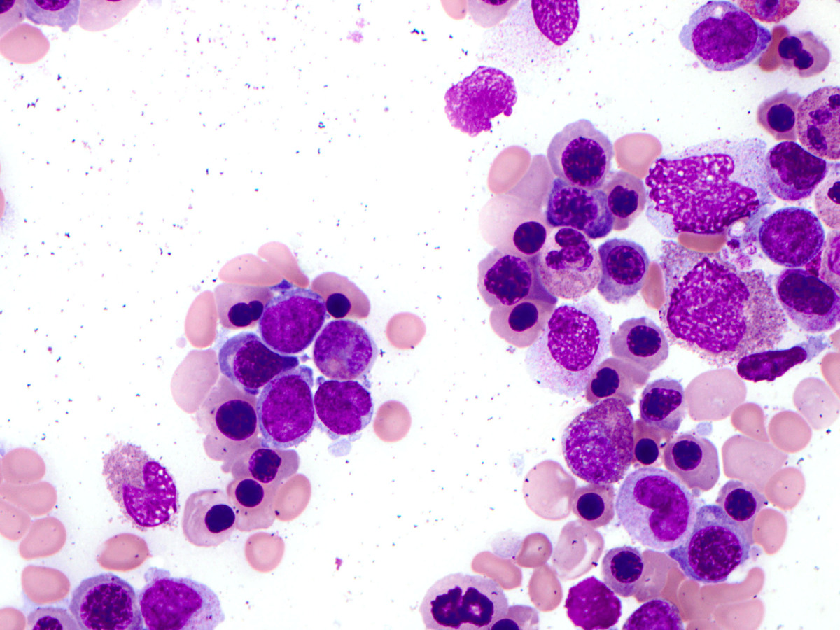 High power view of first bone marrow aspirate showing erythroid dysplasia, monocytes, and occasional myeloid blasts.