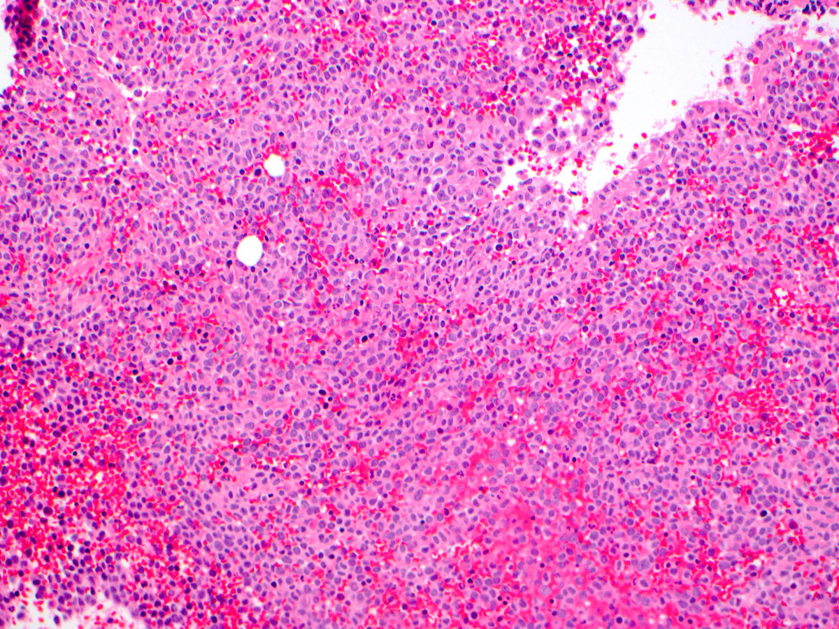 Low power view of second bone marrow biopsy showing a hypercellular marrow composed mainly of blast forms.