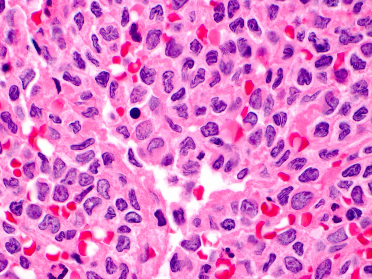 High power view of second bone marrow biopsy showing sheets of immature monocytoid cells with irregular and lobated nuclei and prominent nucleoli, consistent with promonocytes and monoblasts.