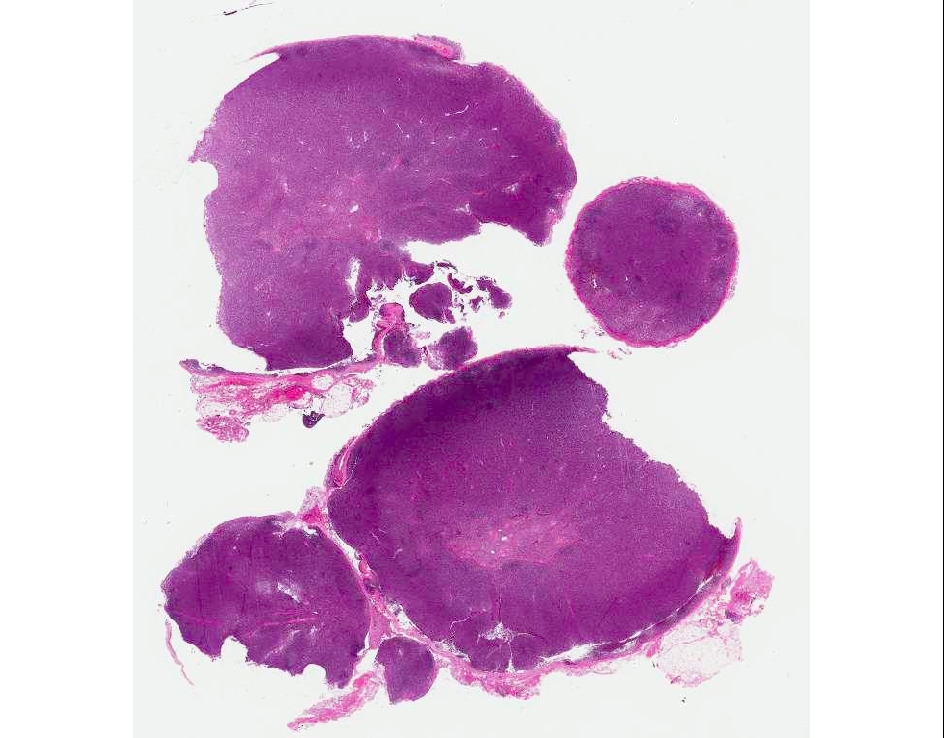 Cervical lymph node biopsy, Hematoxylin and eosin stain, 1X objective