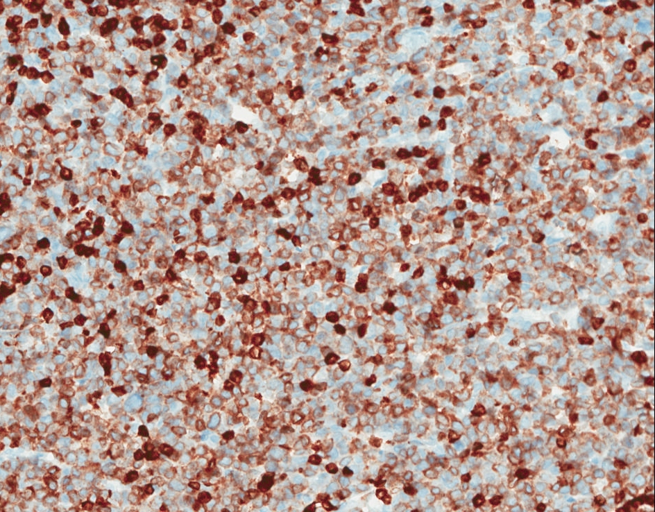 Cervical lymph node biopsy, CD3, 20X objective