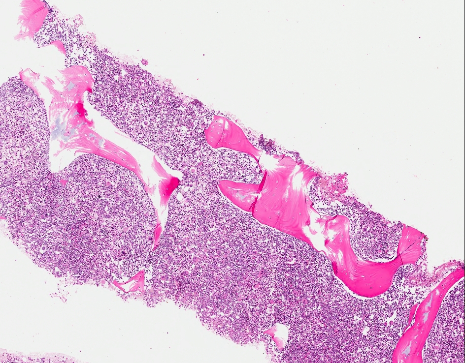 Bone marrow biopsy, Hematoxylin and eosin stain, 4X objective
