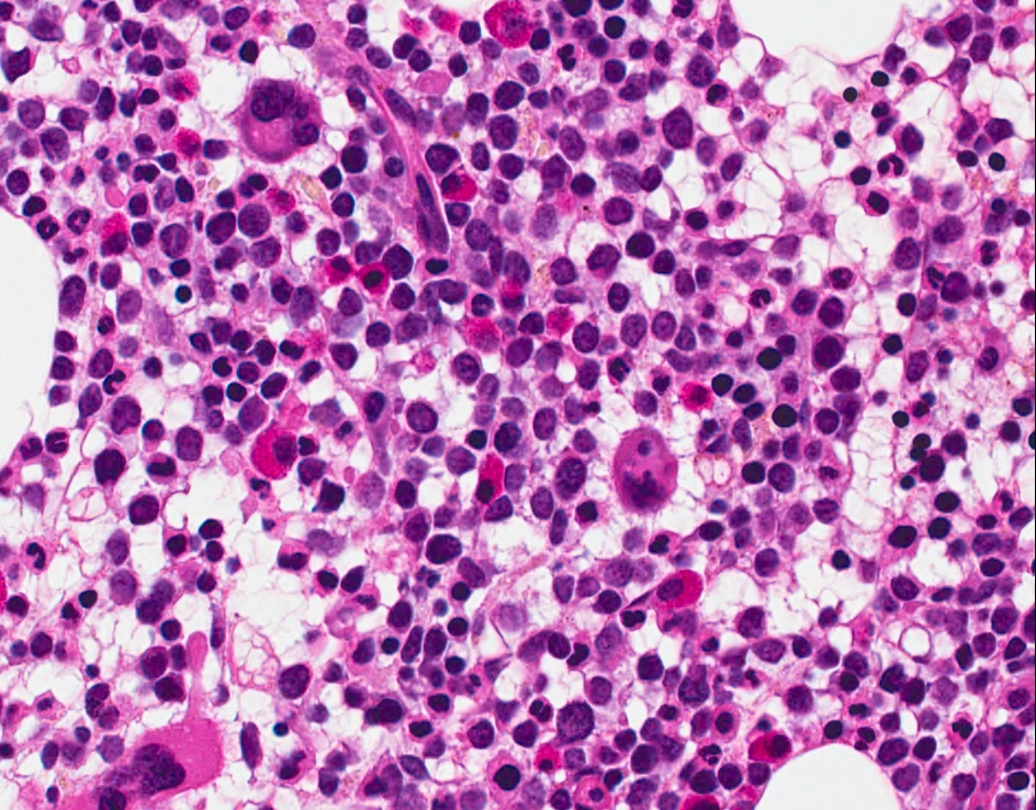 Bone marrow biopsy, Hematoxylin and eosin stain, 40X objective