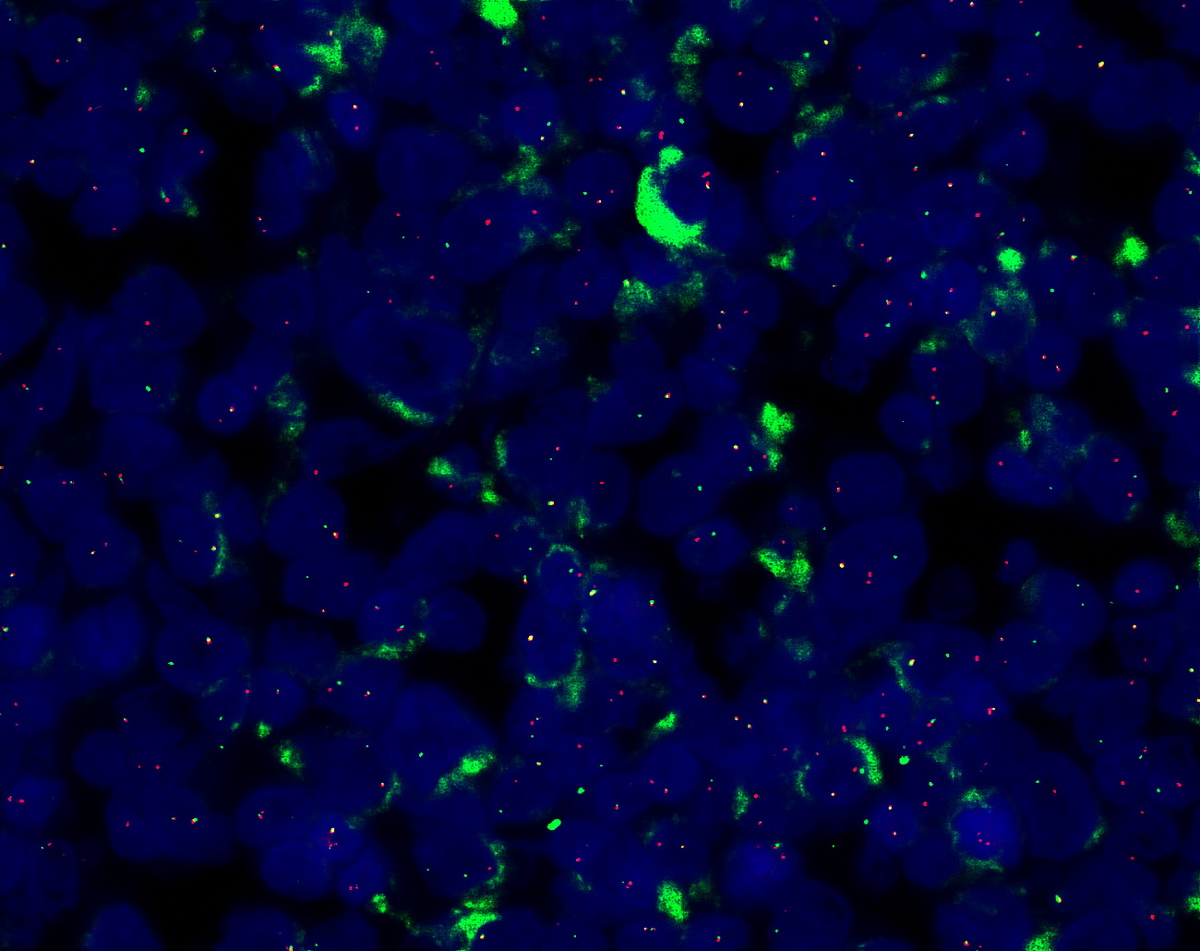 Fluorescence in situ hybridization using a dual color, break apart probe is positive for MLL (11q23) translocation